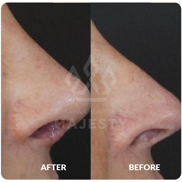 تجميل الأنف