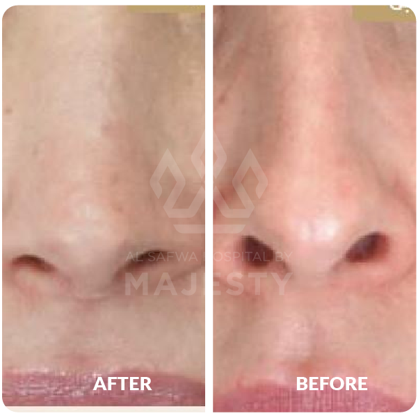 تجميل الأنف