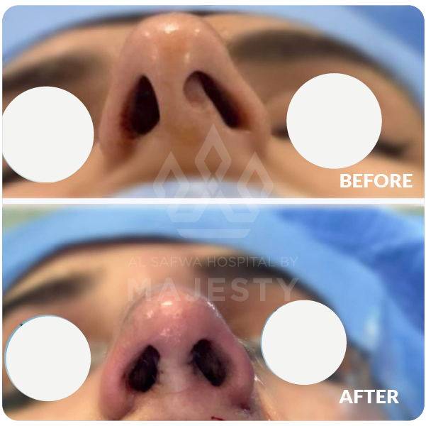 تجميل الأنف