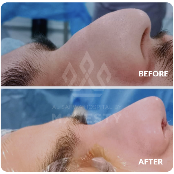 عملية تجميل الأنف