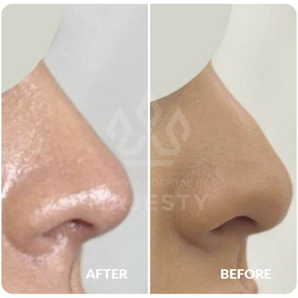 عملية تجميل الأنف