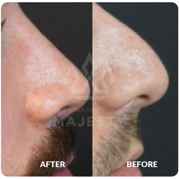 تجميل الأنف