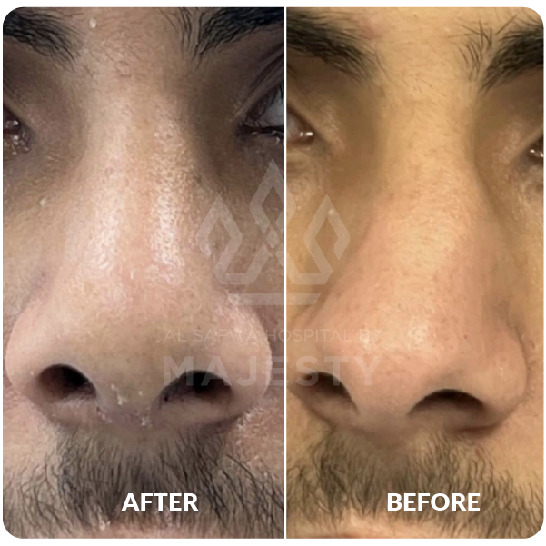 Rhinoplasty