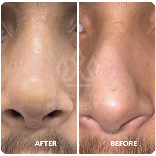 تجميل الانف