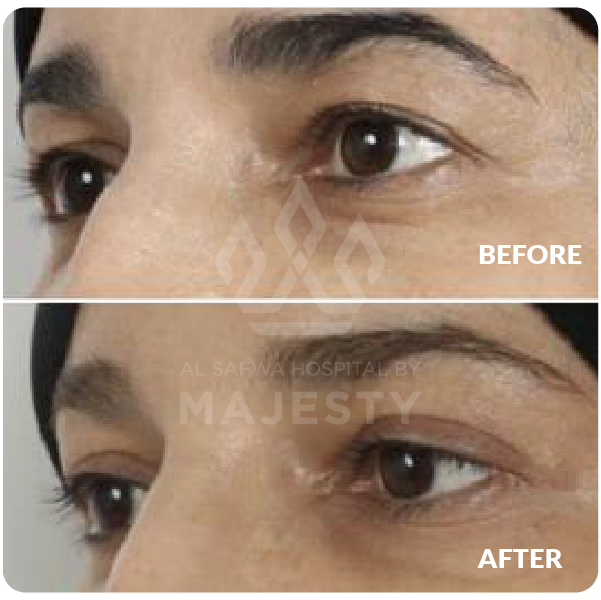 تجميل الجفون العلوية