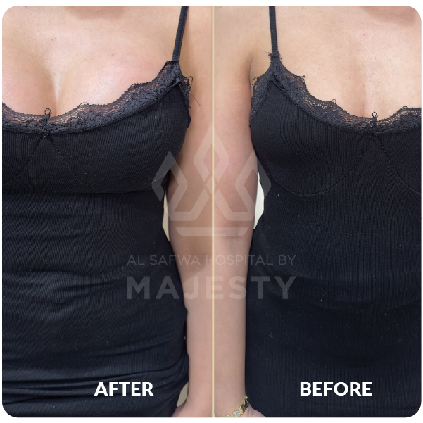 عملية تكبير الصدر بحشوات السيليكون
