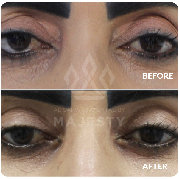 رفع الحواجب