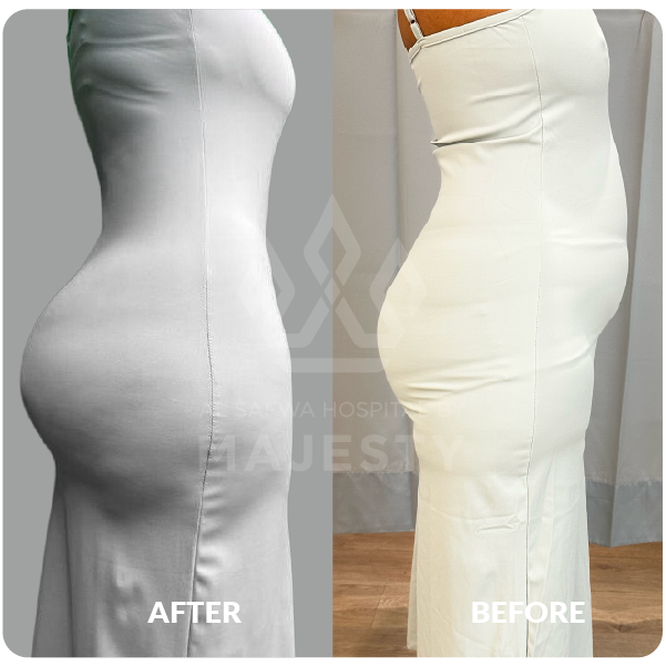 شد البطن الجراحي وشفط 360 مع الحقن البرازيلي