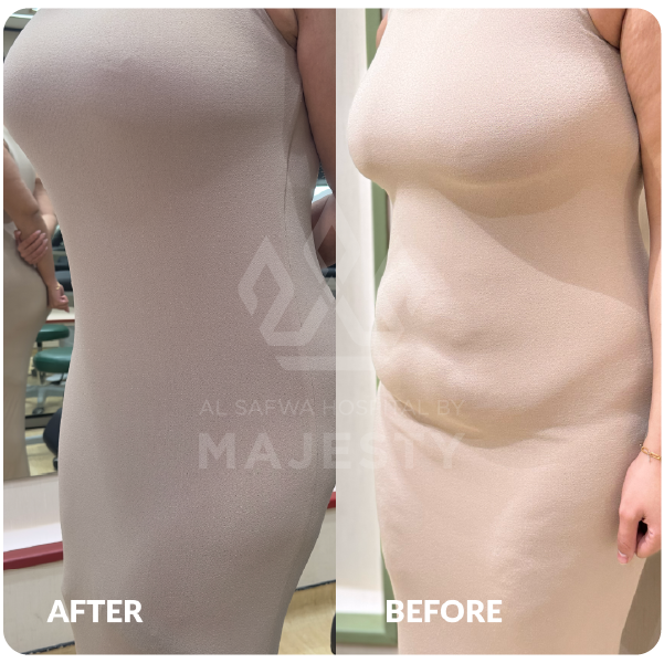 تصغير الصدر