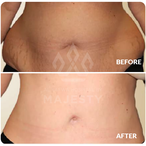 عملية شد البطن