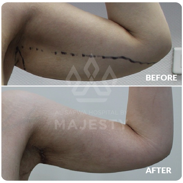 شد الذراعين