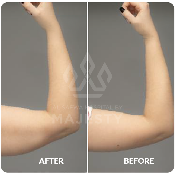 عملية شد الذراعين