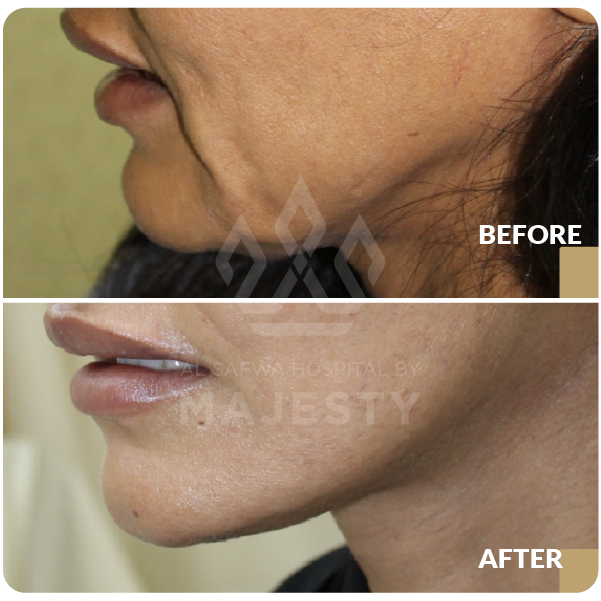 شد الوجه والرقبة