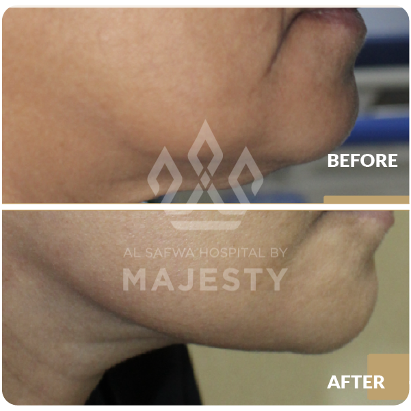 شد الوجه والرقبة