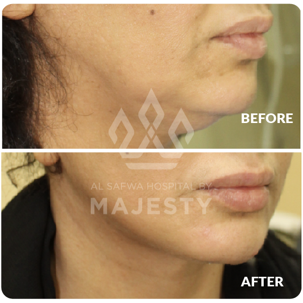 شد الوجه والرقبة