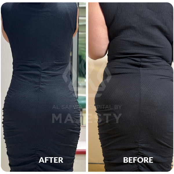 شد حزامي 360 درجة مع اعادة حقن المؤخرة 2