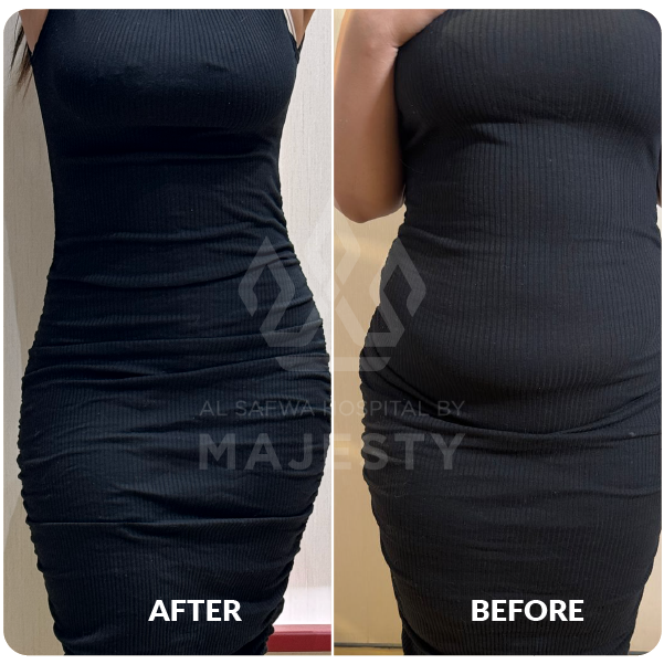 شد حزامي 360 درجة مع اعادة حقن المؤخرة