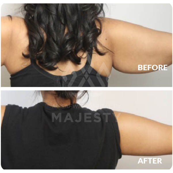 شد الذراعين