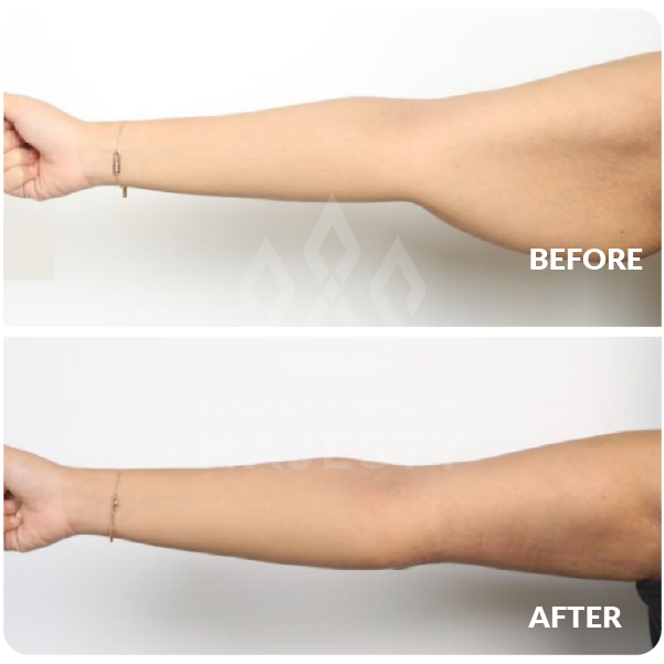 شد الذراعين