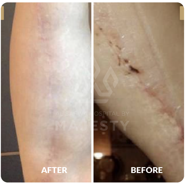 الفراكشنال ليزر