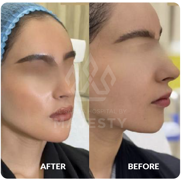 فيلر الشفايف وتحديد الذقن