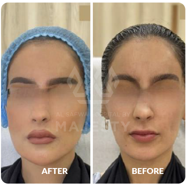 فيلر الشفايف وتحديد الذقن 2