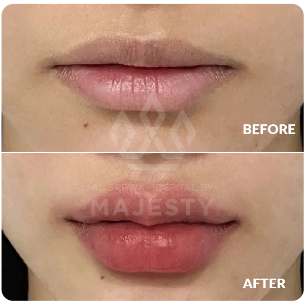 فيلر الشفايف