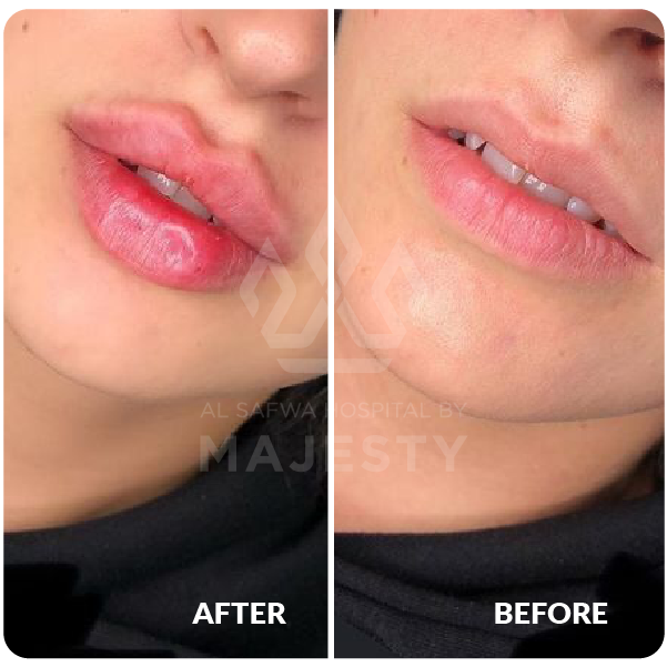 فيلر الشفايف