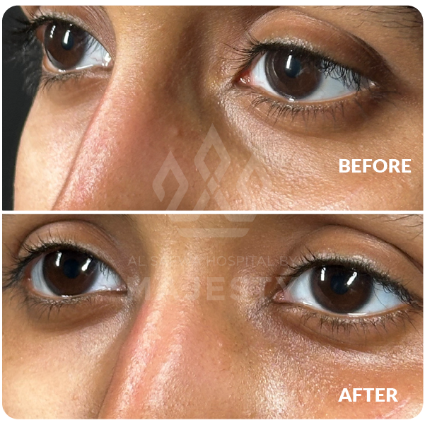 فيلر تحت العين