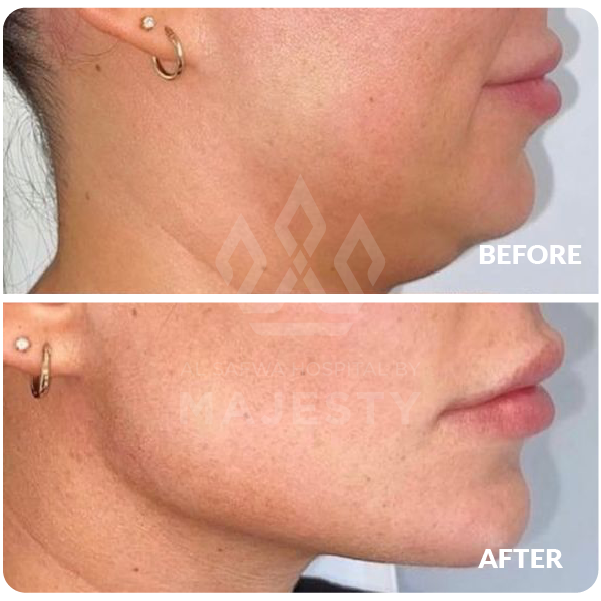 فيلر تحديد الذقن – تكساس