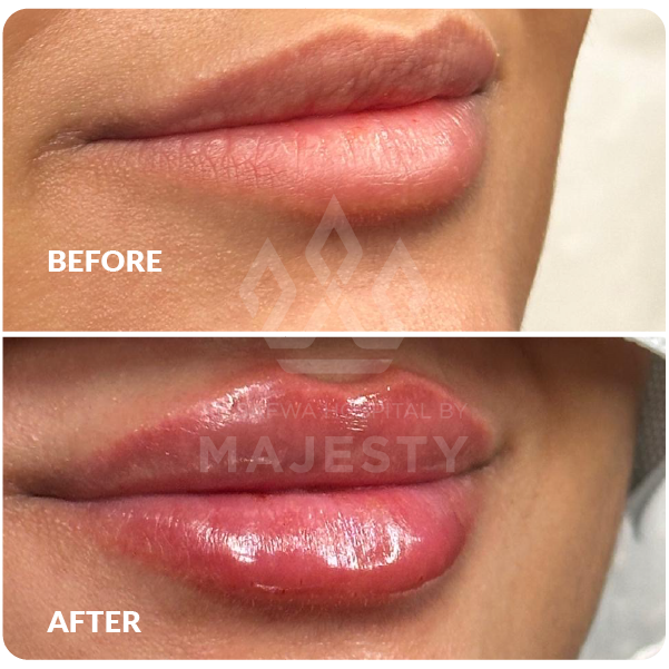 فيلر شفايف كامل