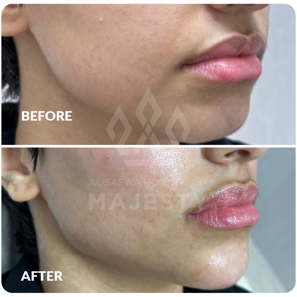 فيلر كامل الوجه