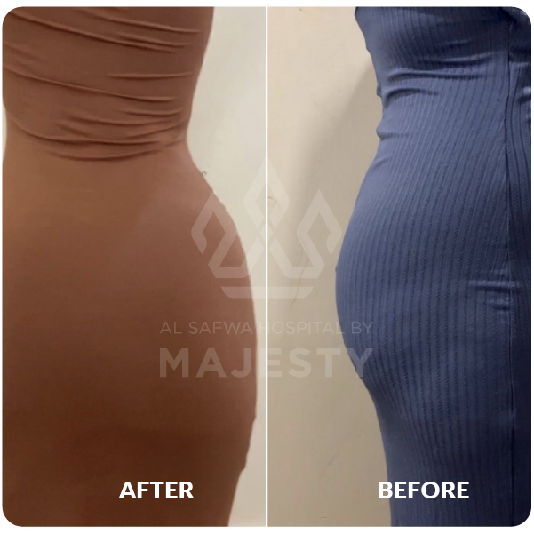 نحت الجسم HD وحقن المؤخرة البرازيلي بدون جراحة