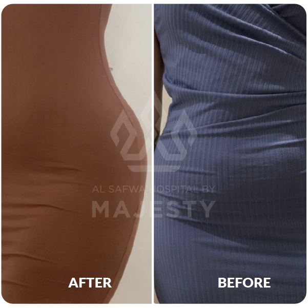 نحت الجسم HD وحقن المؤخرة البرازيلي بدون جراحة 2