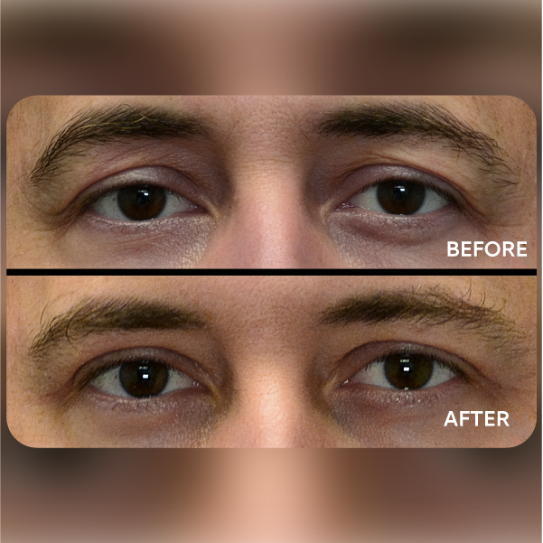 قص الجفون العلوية