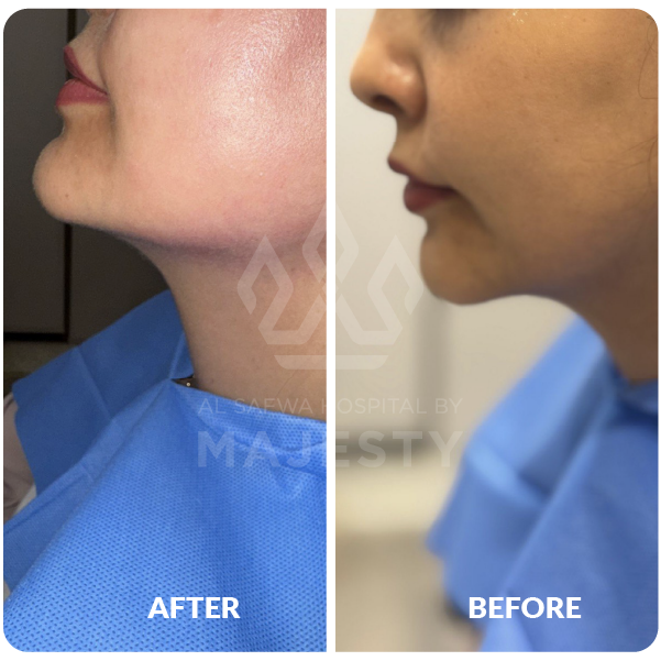 الشد الغير جراحي