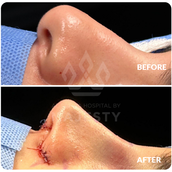 تجميل الانف