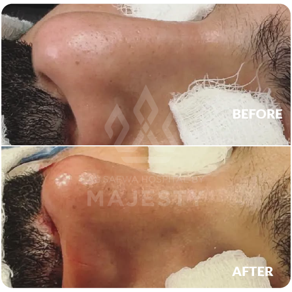 تجميل الانف