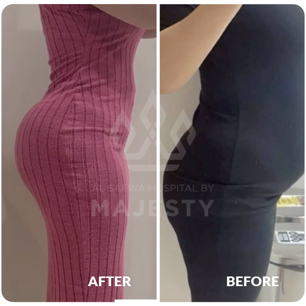 شفط وشد البطن