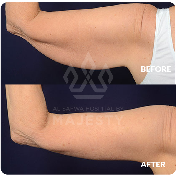 شد الذراعين