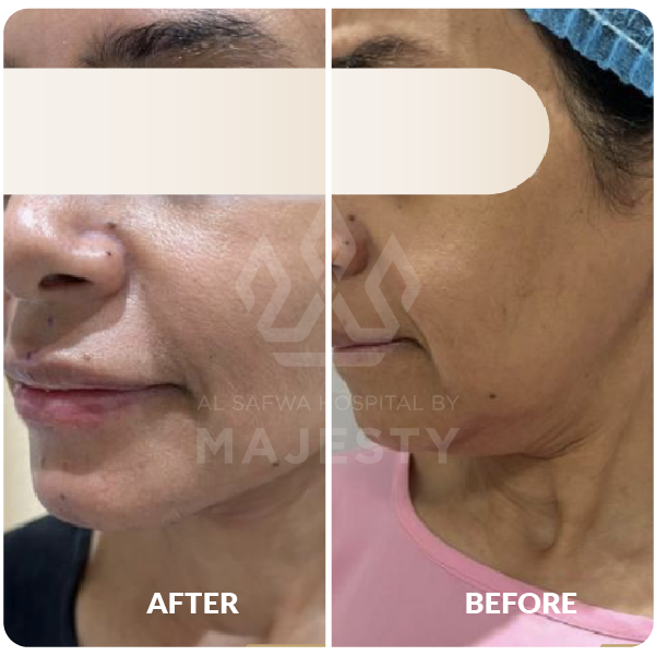 شد الوجه والرقبة مع حقن الدهون