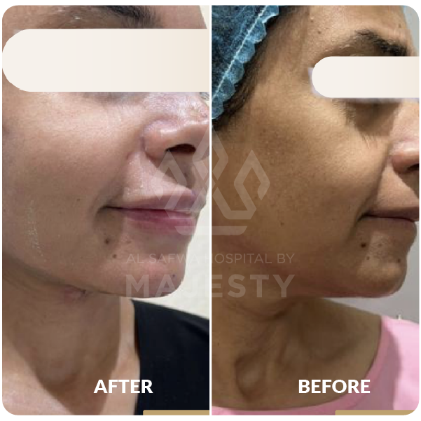 شد الوجه والرقبة مع حقن الدهون