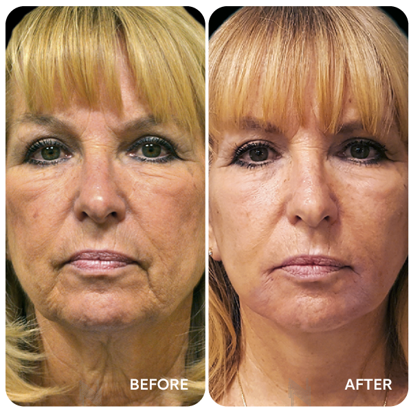 شد الوجه والرقبة