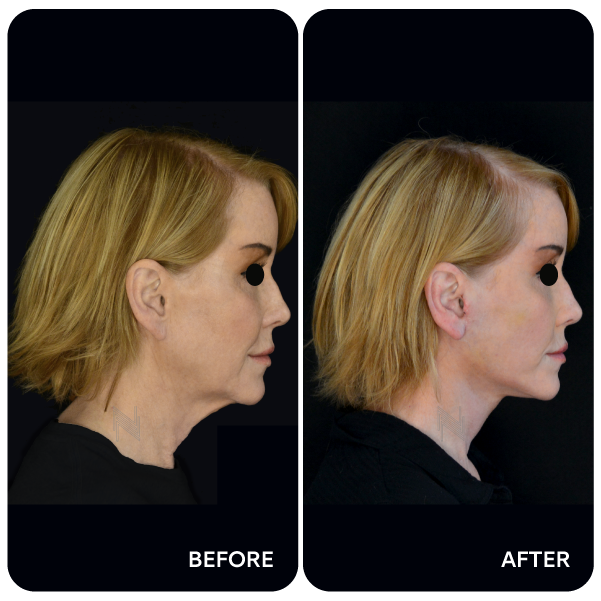 شد الوجه والرقبة