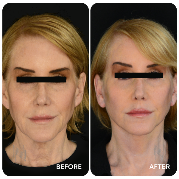 شد الوجه والرقبة