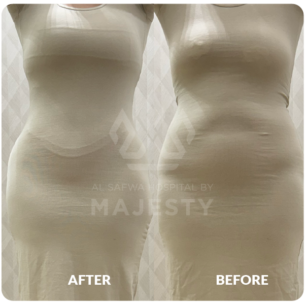 شد البطن والصدر