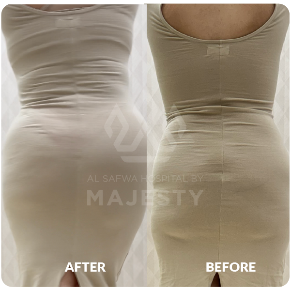 سيلكون وتعبئة خفسات