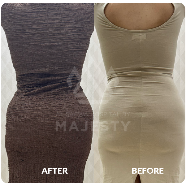 سيلكون وتعبئة خفسات