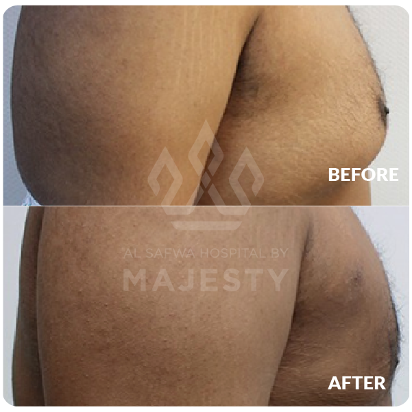 علاج التثدي