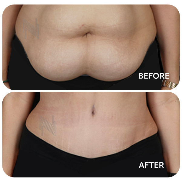 شفط دهون البطن